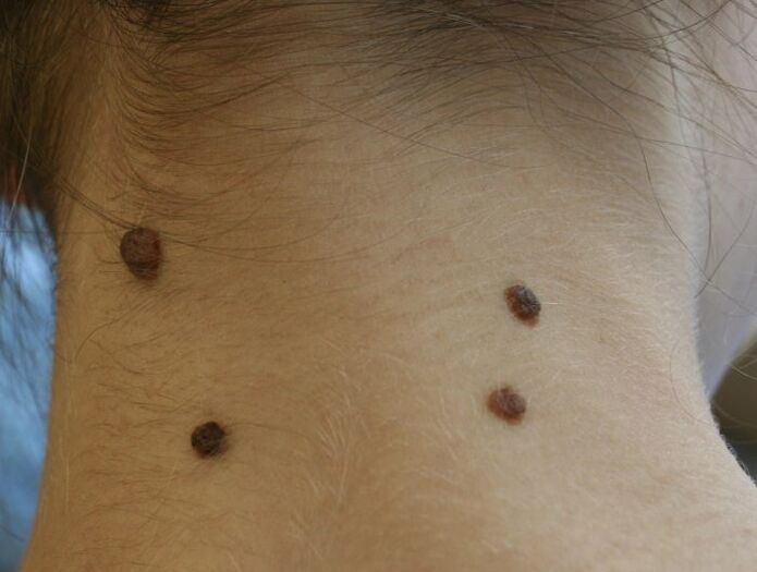 What does a papilloma on the neck look like 