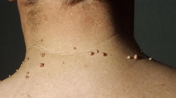 Filamentous papilloma of neck