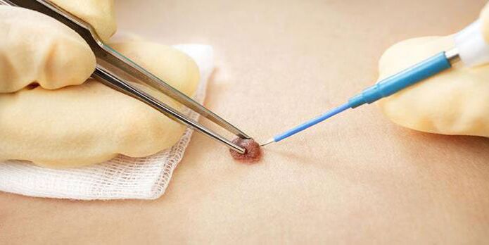 Electrocoagulation surgery effectively removes papillomas
