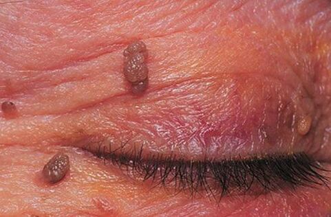Papillomas on the eyelid skin require treatment