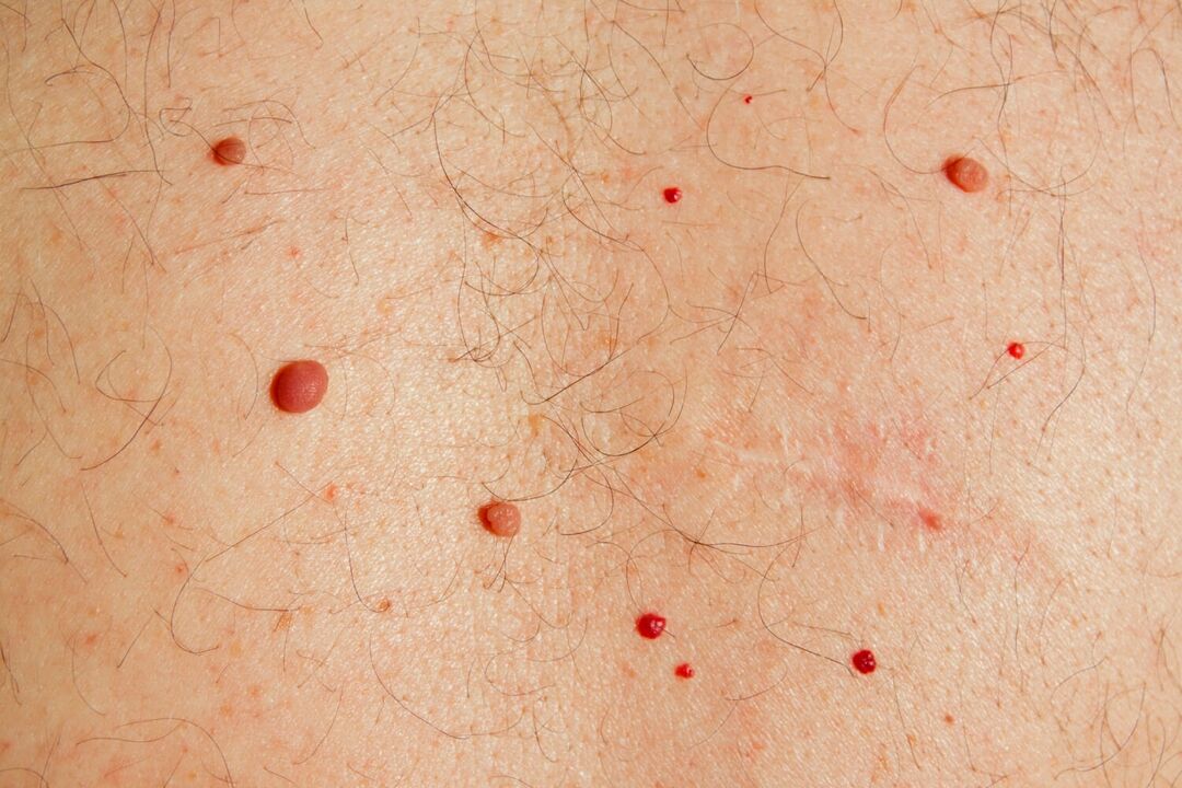 Body papillomas caused by HPV