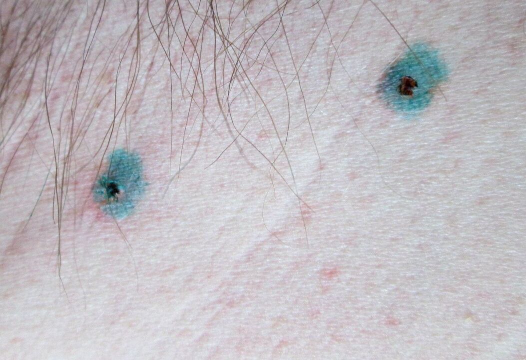 Marks on skin after laser papilloma removal
