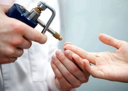 Using liquid nitrogen to remove warts from fingers