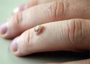 a wart on the finger