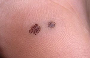 a wart on the palm of the hand