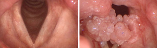 Papilloma virus in the mouth